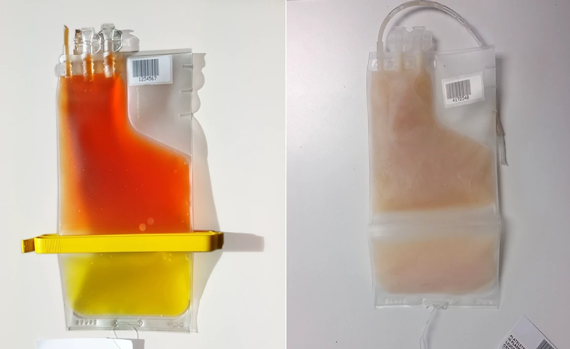 A side-by-side comparison of two medical blood product bags, one containing a red and yellow fluid mixture which are the fresh platelets and the other a more translucent, pale substance, representing the frozen platelets.